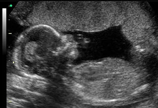 Fetal ultrasound, showing the profile of a fetus with its head and body.