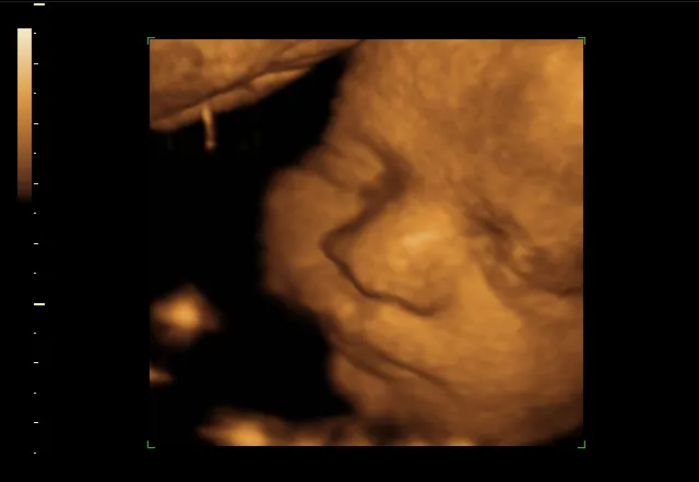3D ultrasound scan showing the face of a fetus, including a nose, eyes, and cheek.