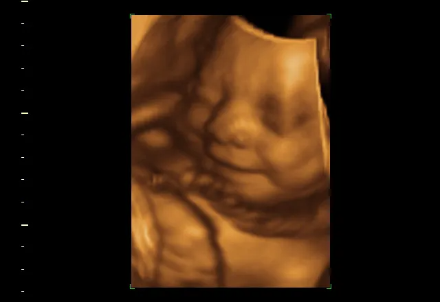 3D ultrasound of a fetus in utero, showing face, nose, and open mouth, in shades of brown.