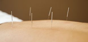 Acupuncture