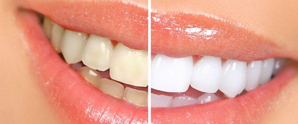 Whitening