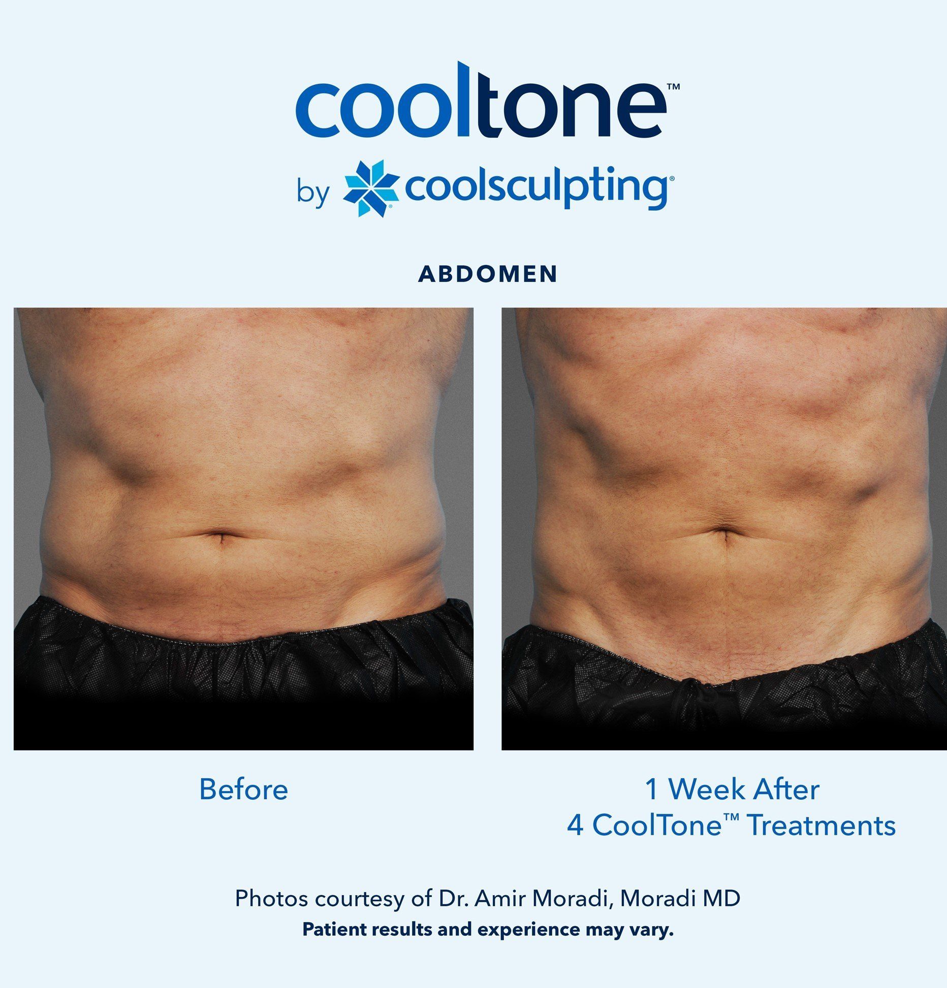 Muscle Toning in Newport Beach, CoolTone