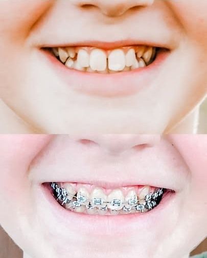 Top shows misaligned teeth; bottom shows the same teeth with braces, smiling.