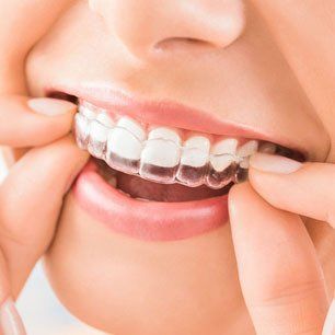 Clear Aligner Therapy