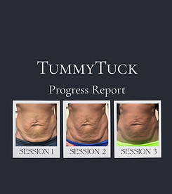 A tummy tuck progress report with three pictures of a woman 's stomach