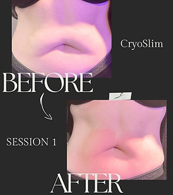 A before and after picture of a woman 's stomach.