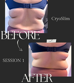 A woman 's back before and after a cryo slim treatment.