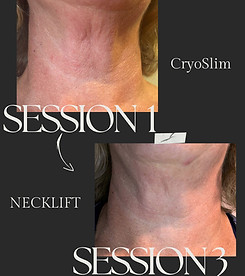 A woman 's neck before and after a cryo slim session