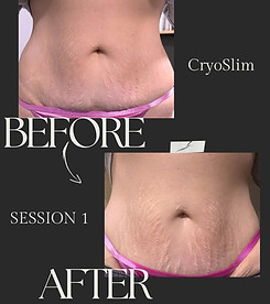 A woman 's stomach is shown before and after a cryo slim treatment.