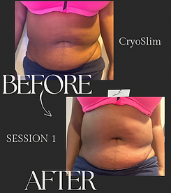 A woman 's stomach before and after a cryo slim session