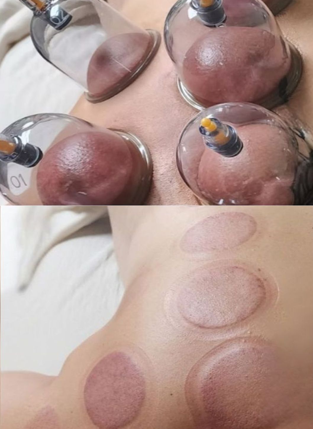 Cupping therapy on a person's torso. Glass cups with a purplish hue and round marks on the skin.