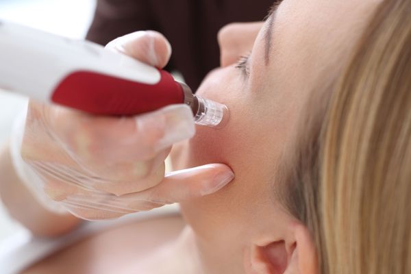 A woman is getting a microdermabrasion treatment on her face.