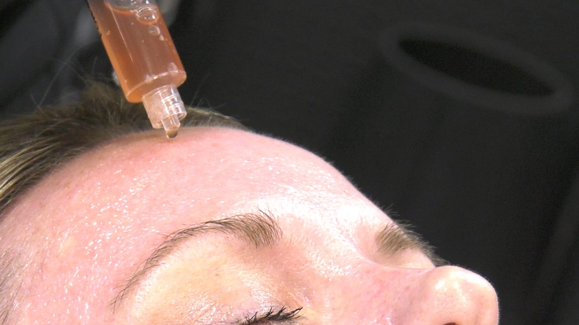 Gloved hand filling a woman’s lower lip with a cosmetic syringe