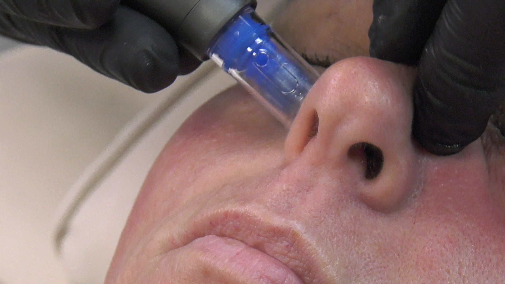 Syringe injecting into a patient’s forehead during a cosmetic procedure