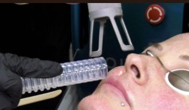 Health worker holding a clear plastic tube near a patient’s nose in a medical setting