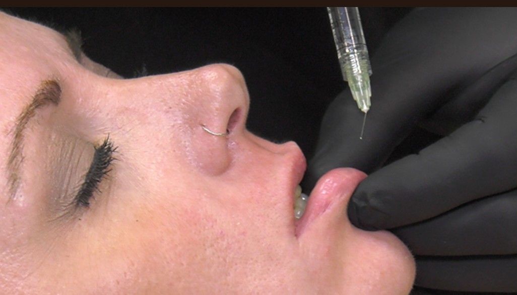 Gloved hand filling a woman’s lower lip with a cosmetic syringe