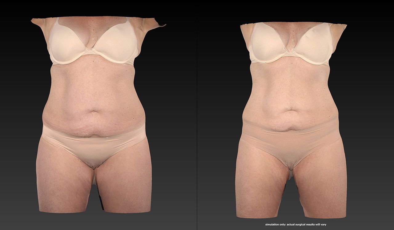 Before and after picture of a female with slimmer body