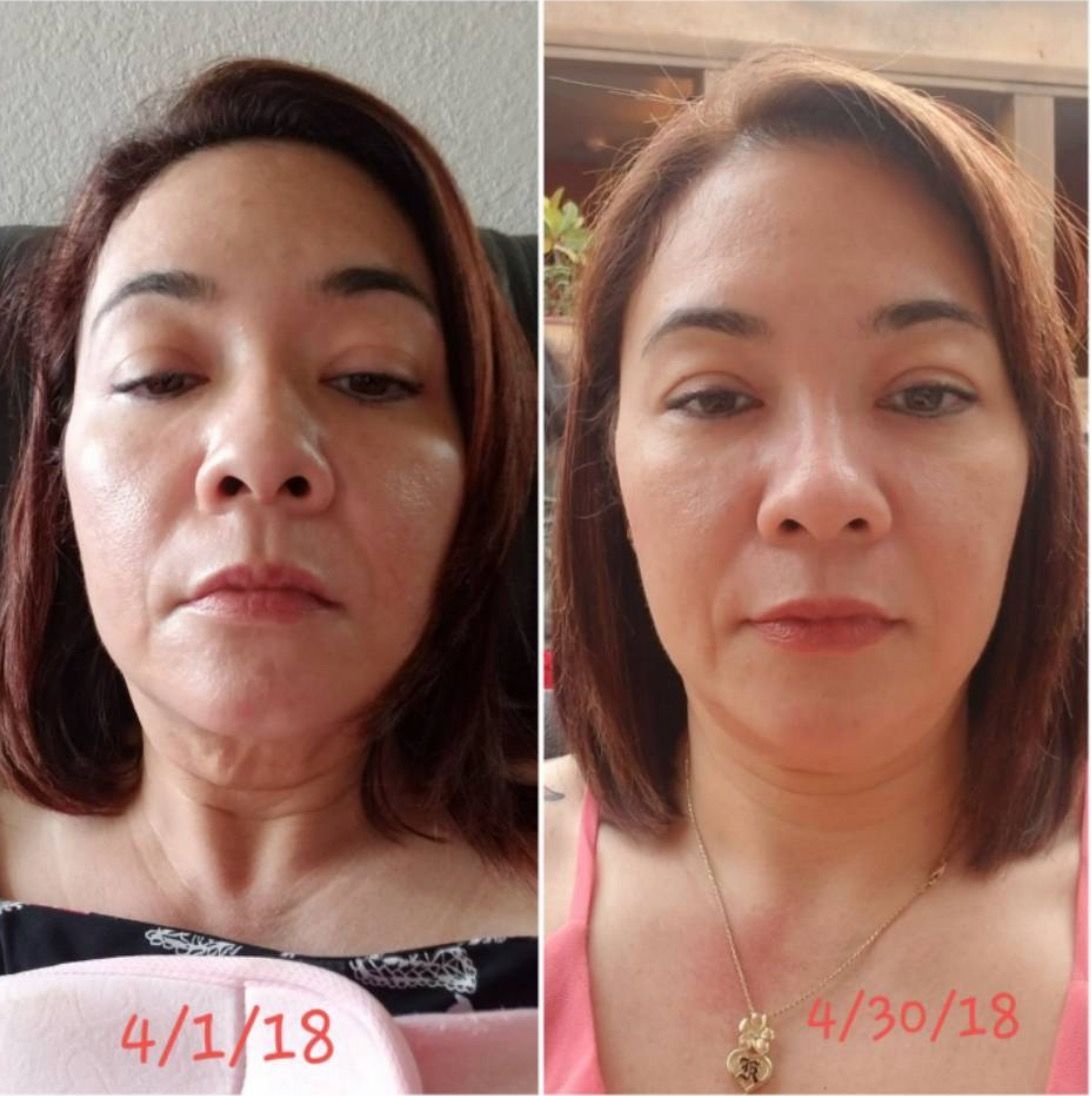 Before and after picture of a woman with smaller neck