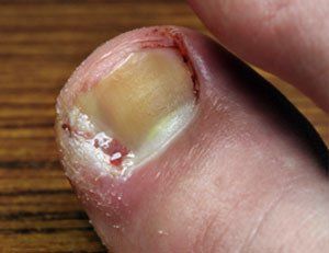 Ingrown nail and fungus nail