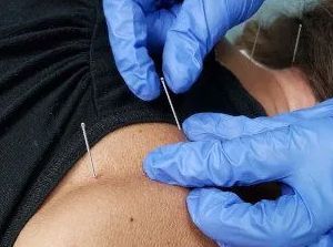 a person is getting dry needling