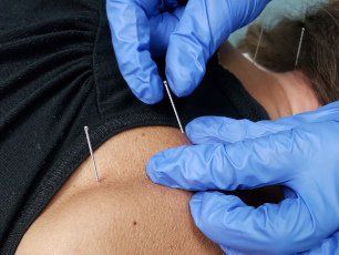 a person is getting dry needling