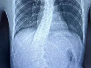 a close-up of an x-ray of a person's chest and stomach 