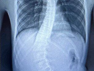 a close-up of an x-ray of a person's chest and stomach 