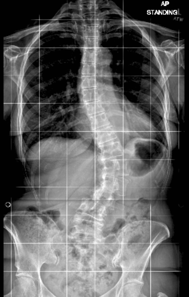 an x-ray of a person's spinal cord