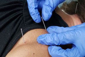 Dry Needling Service