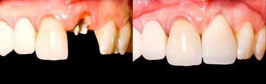 Before and after photo of dental crown