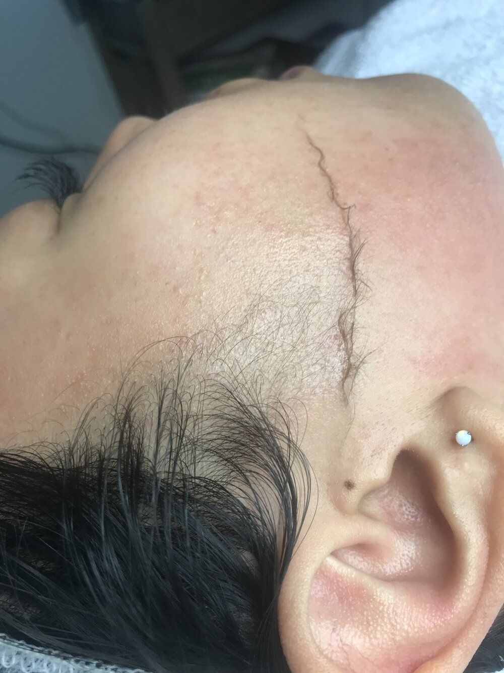 process of dermaplaning