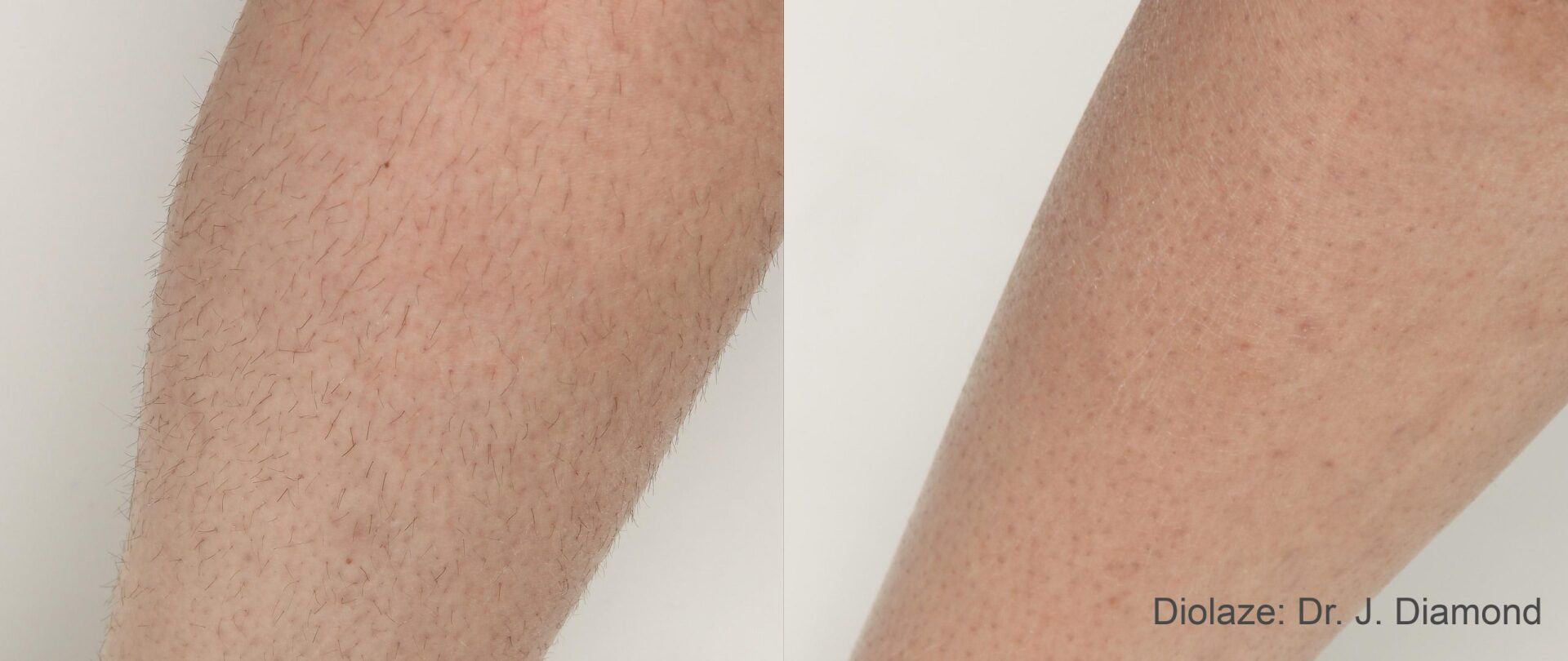 A before and after photo of a person 's legs.