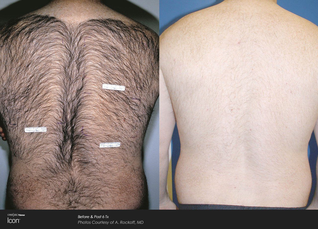 A before and after picture of a man 's hairy back