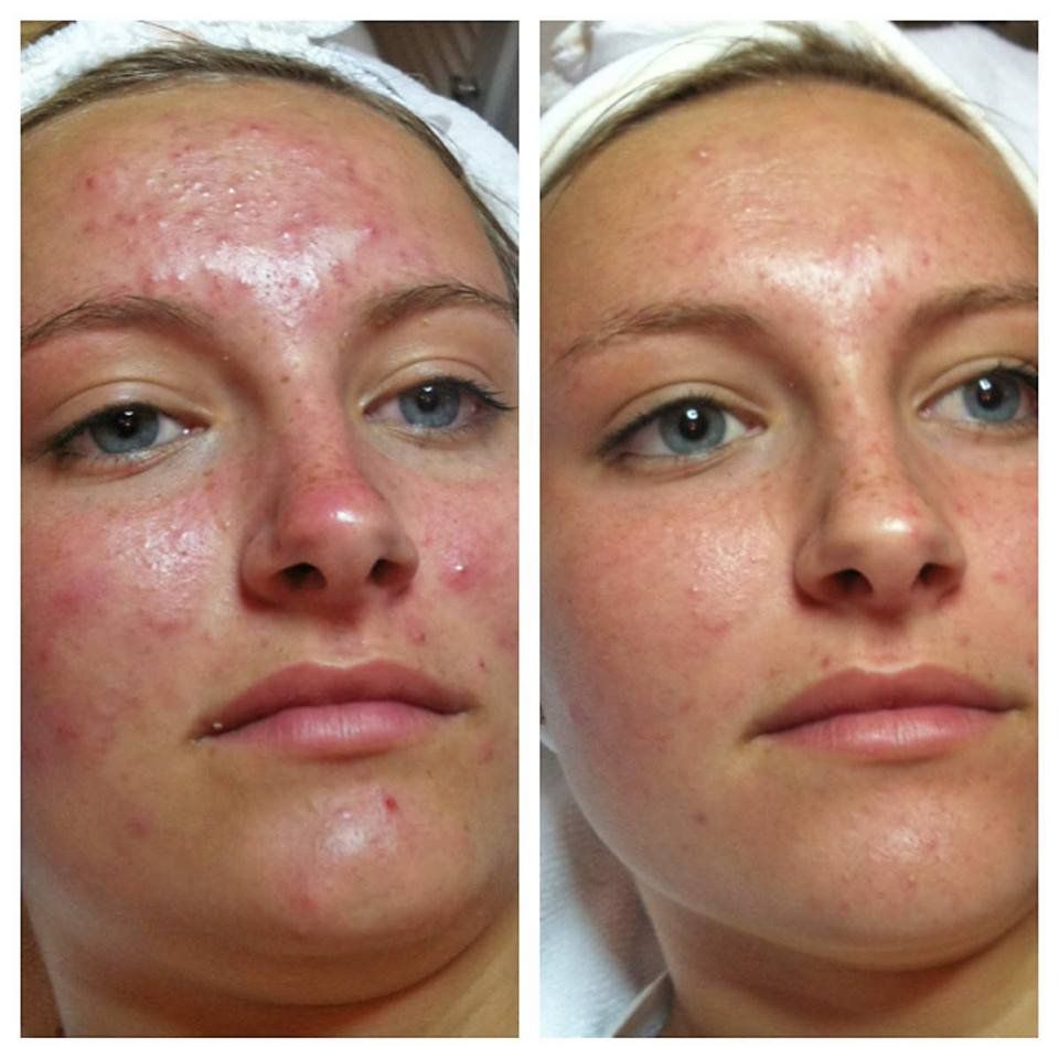 A before and after photo of a woman 's face with acne