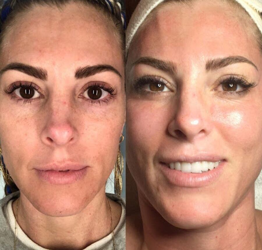 A before and after photo of a woman 's face.