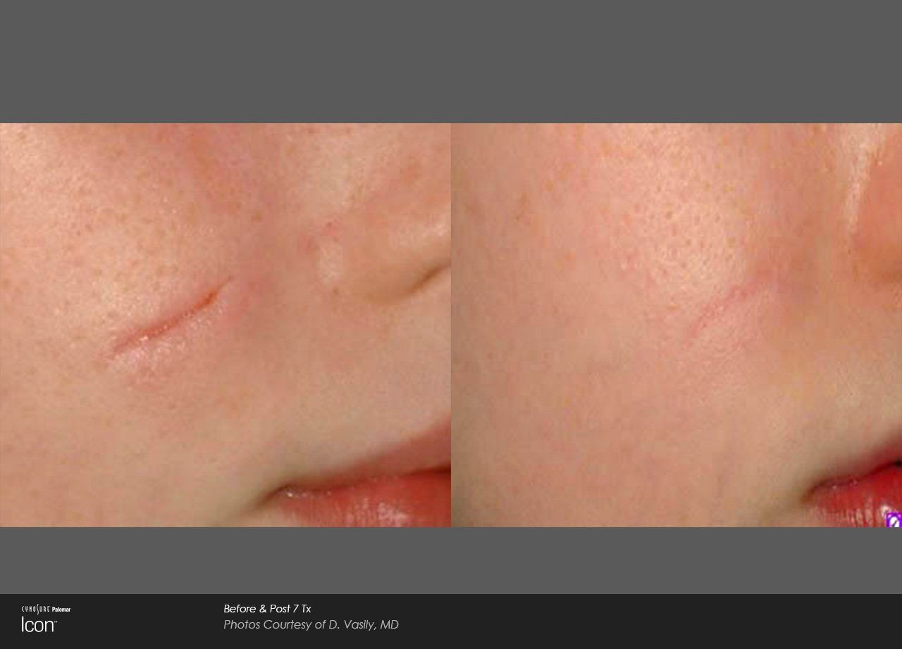 A before and after photo of a person 's face with a scar