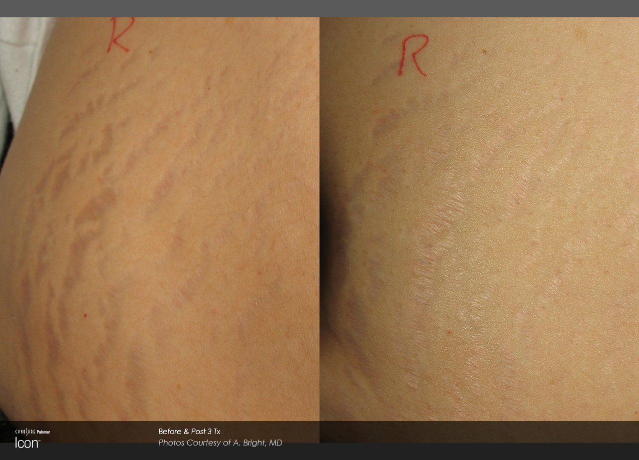 A before and after photo of stretch marks on a woman 's back