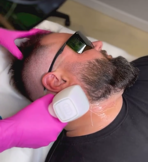 laser hair removal in men