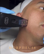 morpheus8 rf microneedling in men