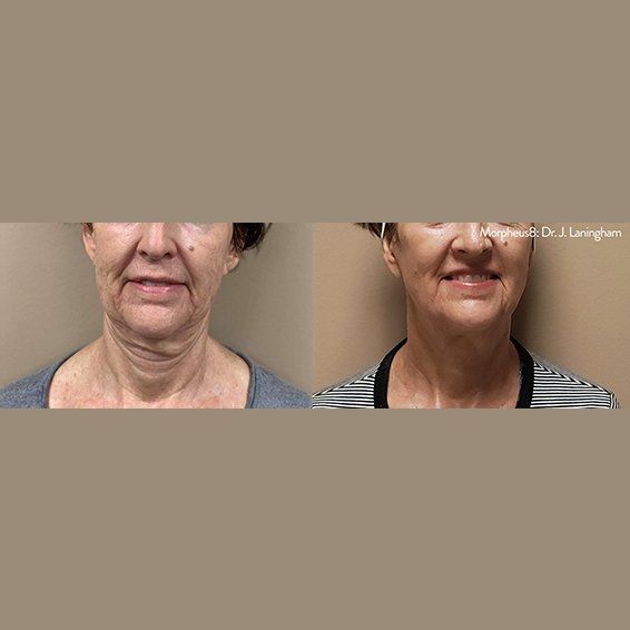 Morpheus8 RF Microneedling before and after photos