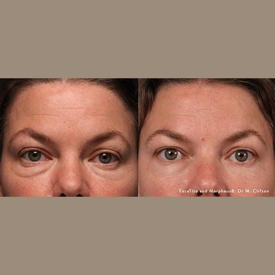 Morpheus8 RF Microneedling treatment