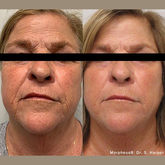 Morpheus8 RF Microneedling results