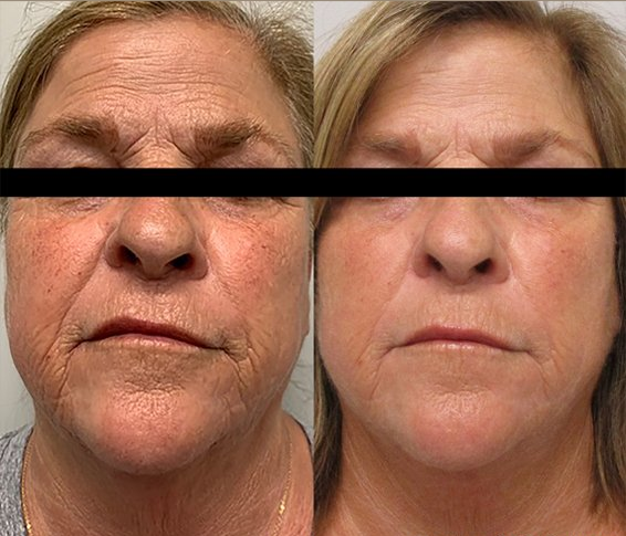 Morpheus8 RF Microneedling results