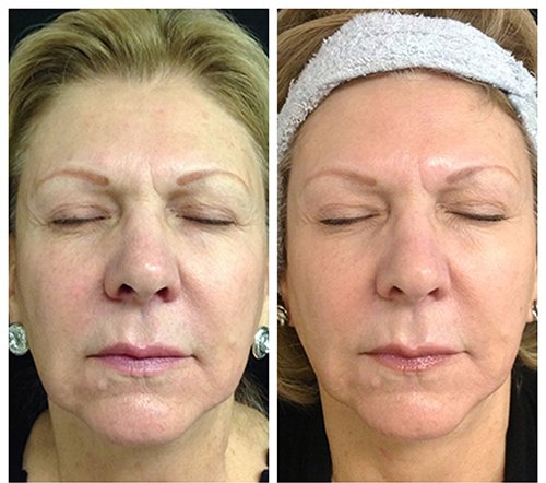 A before and after photo of a woman 's face with her eyes closed.