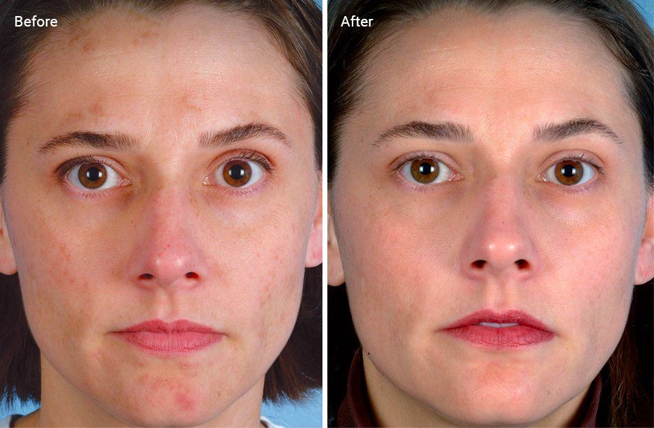A before and after photo of a woman 's face.