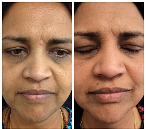 A before and after photo of a woman 's face.