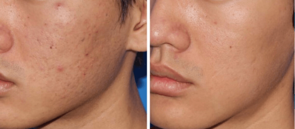 A before and after photo of a man 's face with acne.