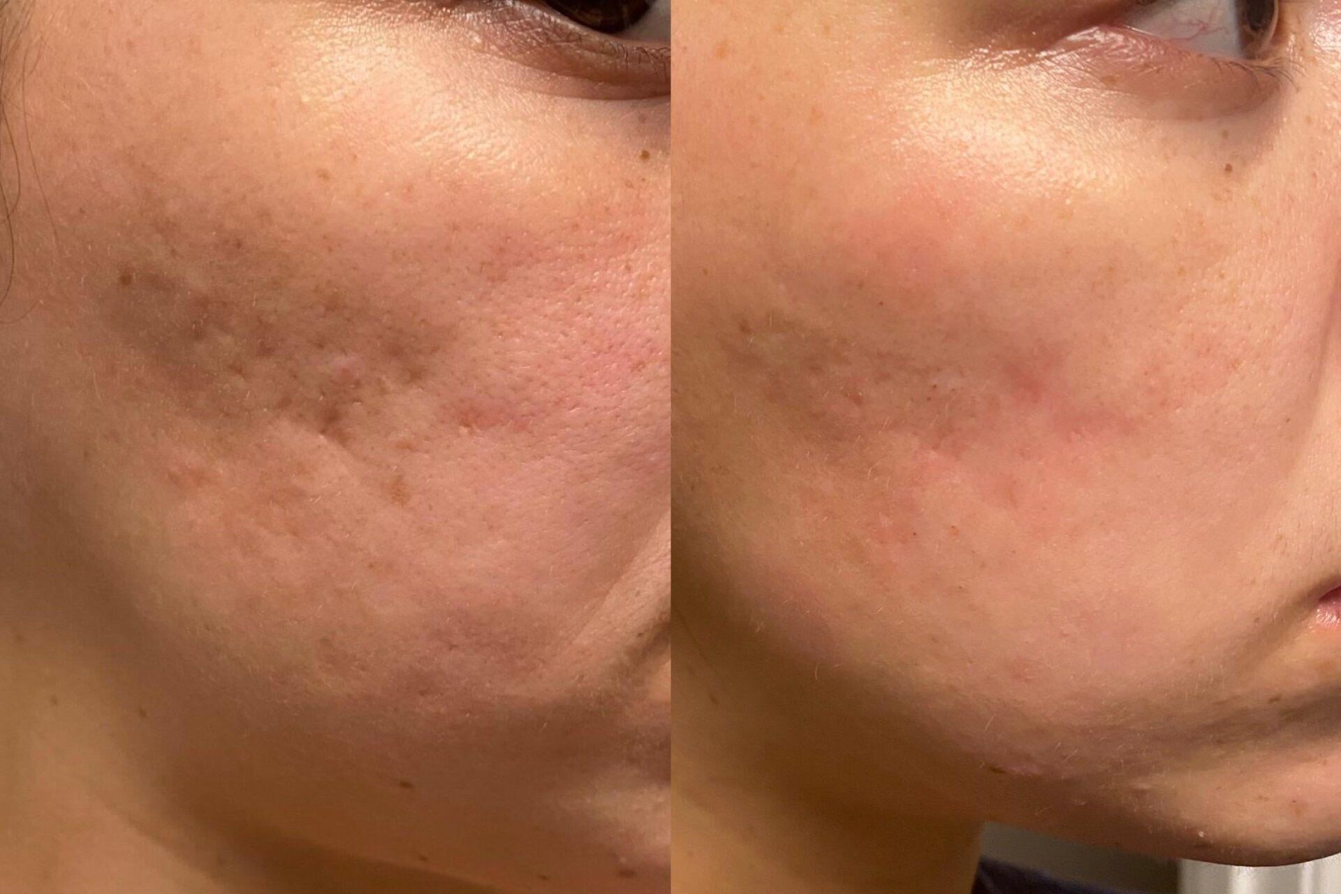 A before and after photo of a woman 's face.