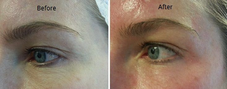 A before and after picture of a woman 's eyebrows.