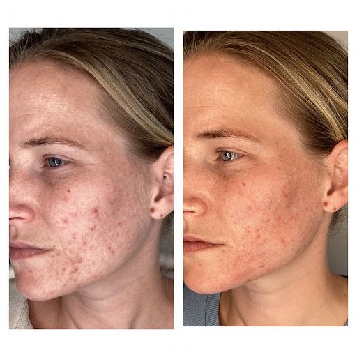 A before and after photo of a woman 's face with acne.